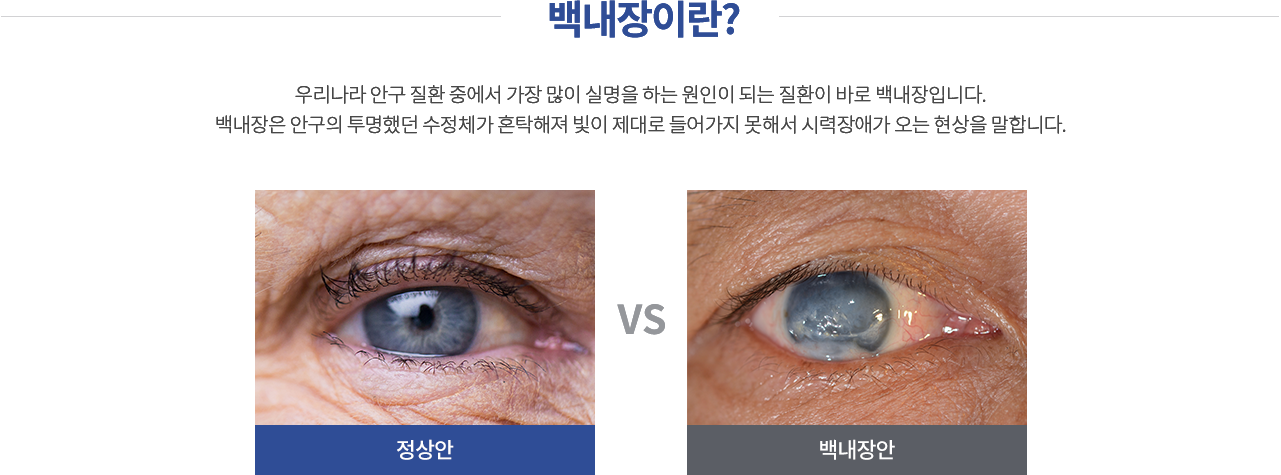 백내장이란?