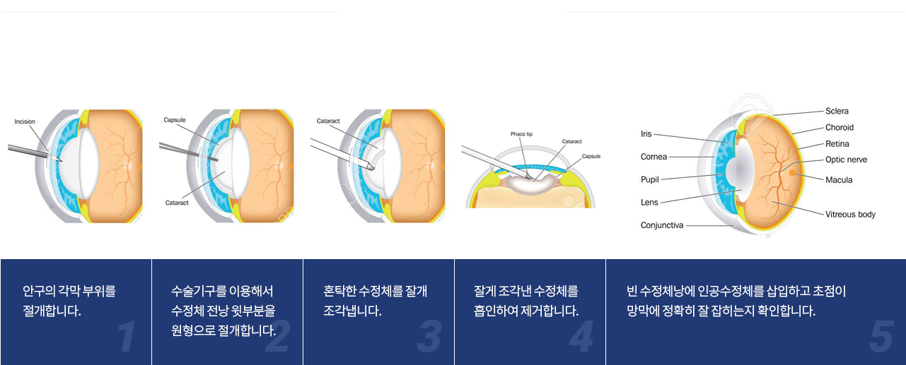 백내장 수술 과정