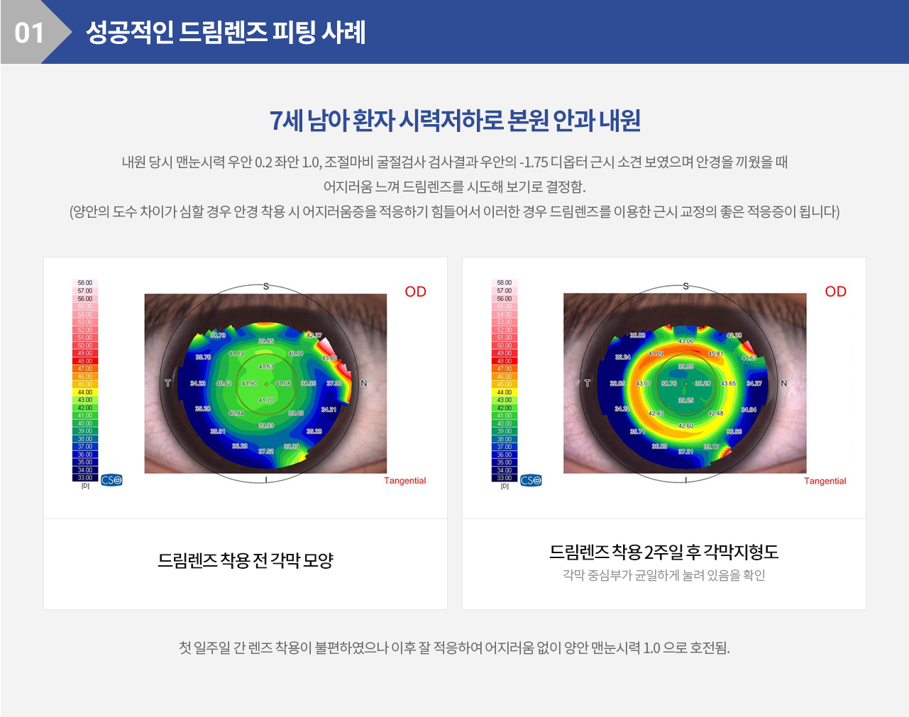 성공적인 드림렌즈 피팅 사례