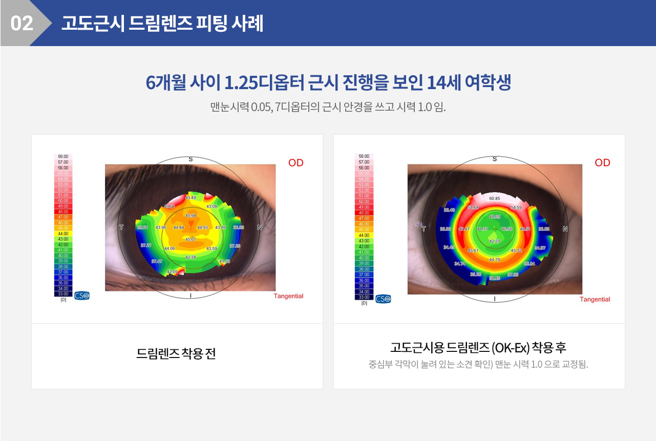 고도근시 드림렌즈 피팅 사례