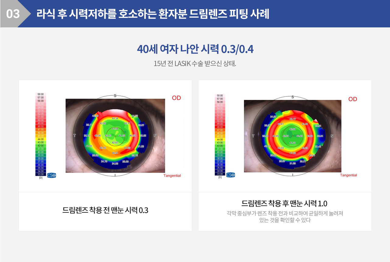 라식 후 시력저하를 호소하는 환자분 드림렌즈 피팅 사례 