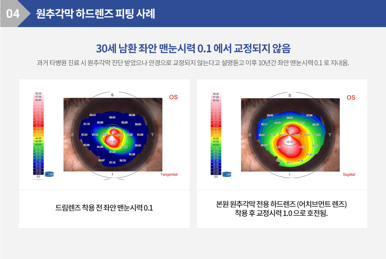 원추각막 하드렌즈 피팅 사례 