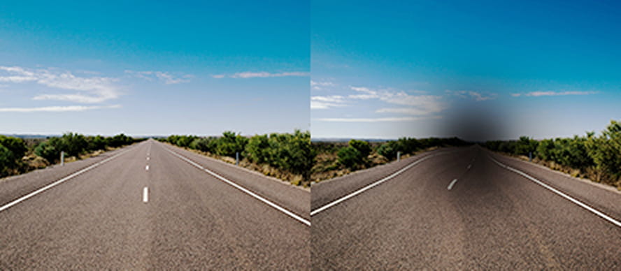 시야의 황변 현상